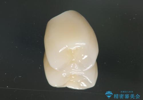 ソケットリフト 骨が薄い上の奥歯のインプラント 50代男性の治療後