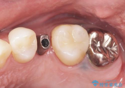 ソケットリフト 骨が薄い上の奥歯のインプラント 50代男性の治療中