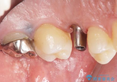 ソケットリフト 骨が薄い上の奥歯のインプラント 50代男性の治療中