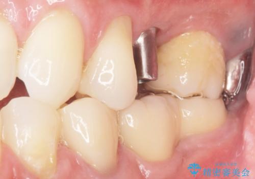 ソケットリフト 骨が薄い上の奥歯のインプラント 50代男性の治療中