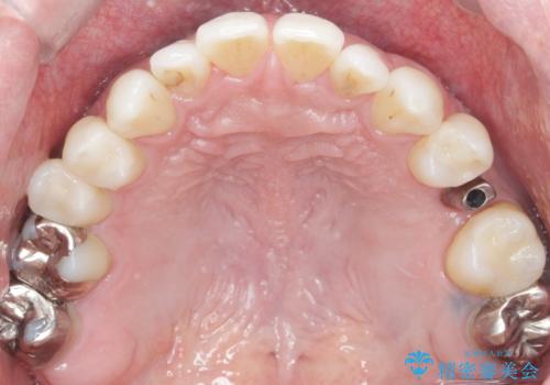 ソケットリフト 骨が薄い上の奥歯のインプラント 50代男性の治療中