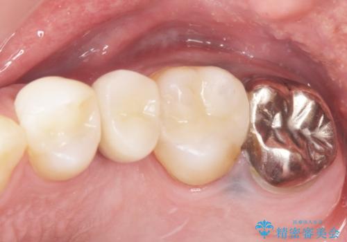 ソケットリフト　骨が薄い上の奥歯のインプラント　50代男性の治療後