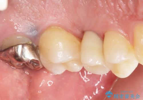 ソケットリフト 骨が薄い上の奥歯のインプラント 50代男性の治療後