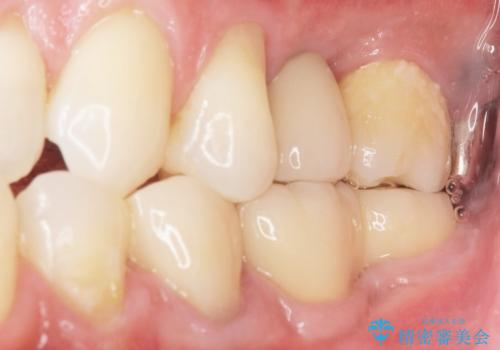 ソケットリフト 骨が薄い上の奥歯のインプラント 50代男性の治療後