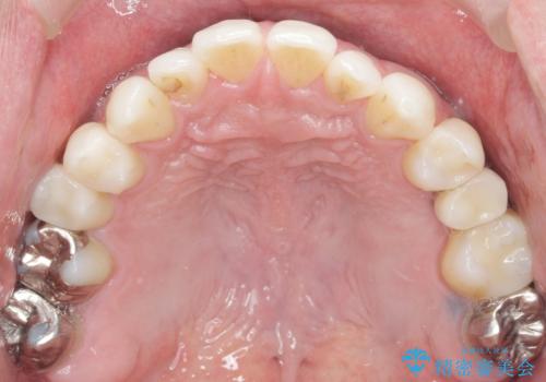 ソケットリフト 骨が薄い上の奥歯のインプラント 50代男性の治療後