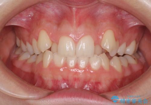 目立つ八重歯を目立たない装置で　ハーフリンガルによる抜歯矯正の症例 治療前