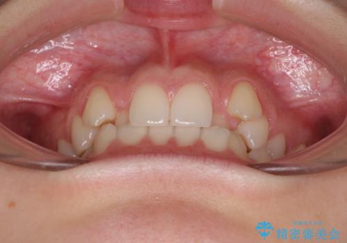 目立つ八重歯を目立たない装置で ハーフリンガルによる抜歯矯正の治療前