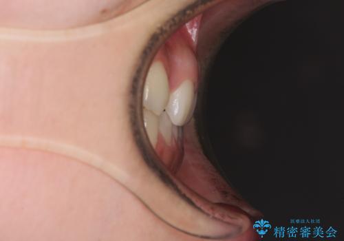 目立つ八重歯を目立たない装置で ハーフリンガルによる抜歯矯正の治療前