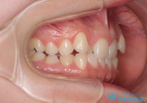 目立つ八重歯を目立たない装置で　ハーフリンガルによる抜歯矯正の治療前