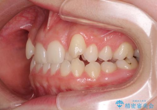 目立つ八重歯を目立たない装置で　ハーフリンガルによる抜歯矯正の治療前