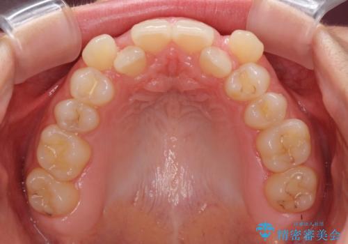 目立つ八重歯を目立たない装置で ハーフリンガルによる抜歯矯正の治療前