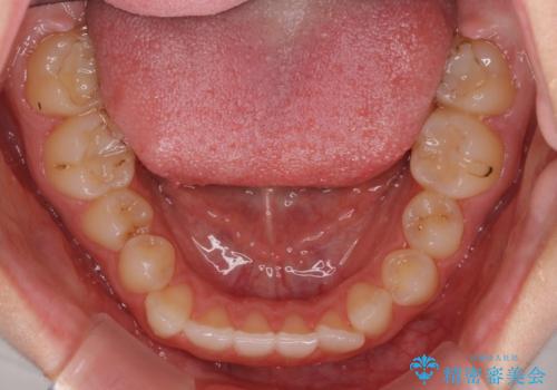 目立つ八重歯を目立たない装置で ハーフリンガルによる抜歯矯正の治療前
