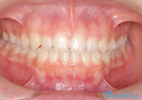 前歯のガタつきを改善　マウスピース矯正とワイヤー部分矯正の症例 治療後