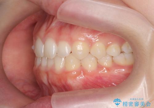 前歯のガタつきを改善　マウスピース矯正とワイヤー部分矯正の治療後