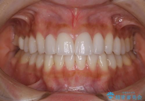 ホワイトニング。前歯のセラミックの被せ物に色見を合わせるの症例 治療前