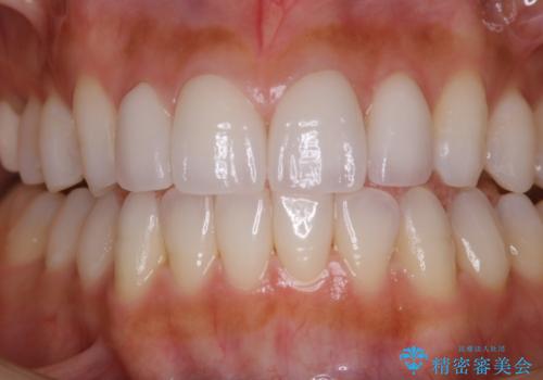 ホワイトニング。前歯のセラミックの被せ物に色見を合わせるの治療前