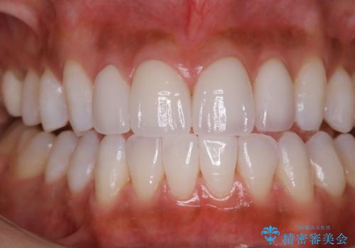 ホワイトニング。前歯のセラミックの被せ物に色見を合わせるの治療後