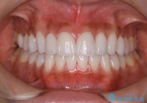 ホワイトニング。前歯のセラミックの被せ物に色見を合わせるの症例 治療後