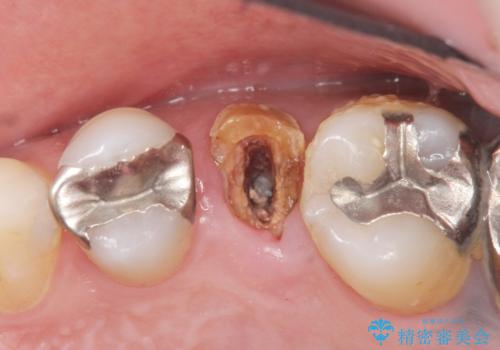 ソケットリフト 骨が薄い上の奥歯のインプラント 50代男性の治療前