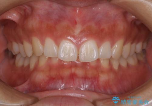 矯正治療前にホワイトニングの治療前