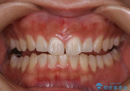 矯正治療前にホワイトニングの治療前