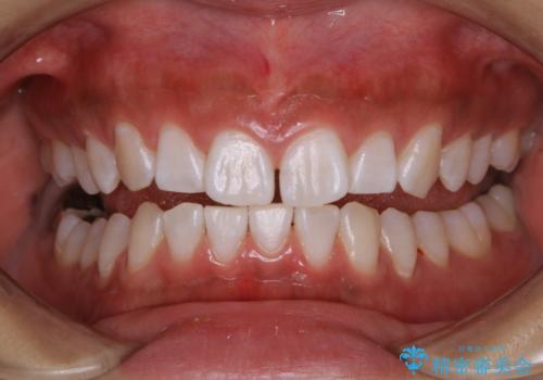 矯正治療前にホワイトニング