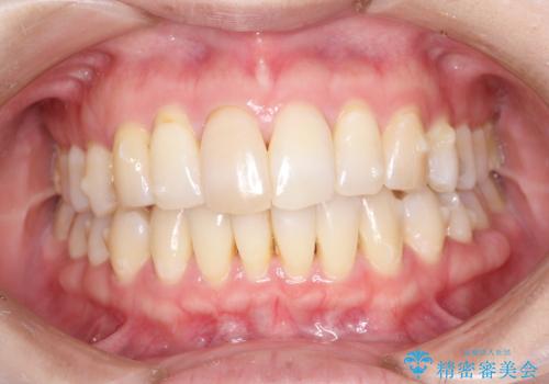 再矯正をインビザラインで目立たず手軽にの治療中