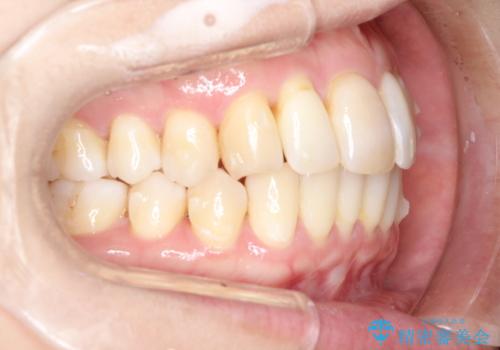 再矯正をインビザラインで目立たず手軽にの治療中