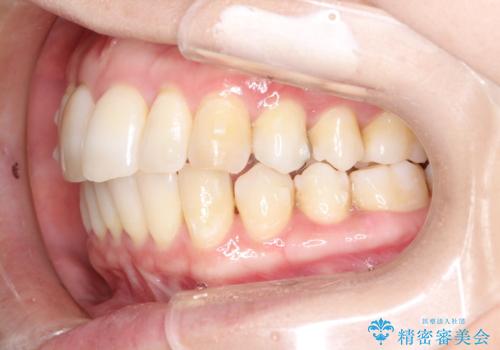再矯正をインビザラインで目立たず手軽にの治療中