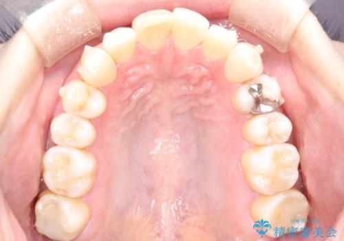 再矯正をインビザラインで目立たず手軽にの治療中