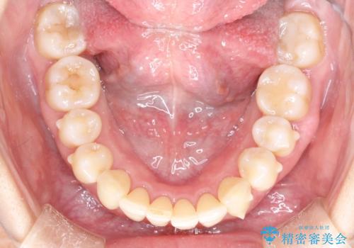 再矯正をインビザラインで目立たず手軽にの治療中