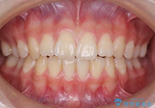 出っ歯 軽度のがたつき インビザラインでの症例 治療前