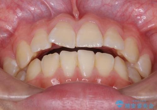 出っ歯 軽度のがたつき インビザラインで