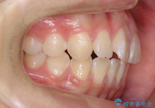 出っ歯 軽度のがたつき インビザラインでの治療前