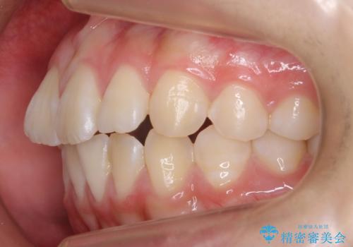 出っ歯 軽度のがたつき インビザラインでの治療前