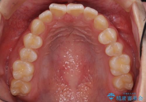 出っ歯 軽度のがたつき インビザラインでの治療前