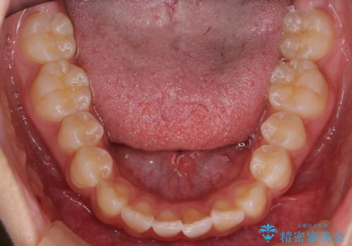 出っ歯 軽度のがたつき インビザラインでの治療前