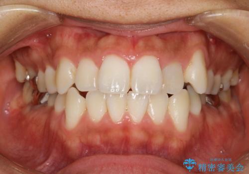 インビザラインで目立たない矯正　ガタガタの歯並びをきれいな歯並びへの症例 治療前