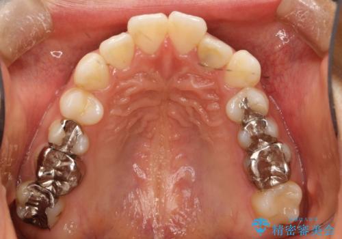 インビザラインで目立たない矯正 ガタガタの歯並びをきれいな歯並びへの治療前