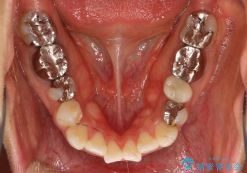 インビザラインで目立たない矯正　ガタガタの歯並びをきれいな歯並びへの治療前