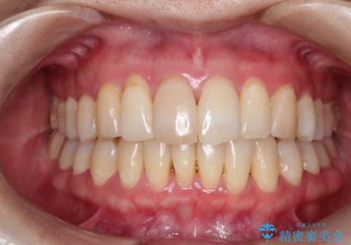 再矯正をインビザラインで目立たず手軽にの治療後