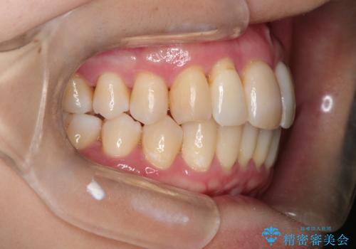 再矯正をインビザラインで目立たず手軽にの治療後