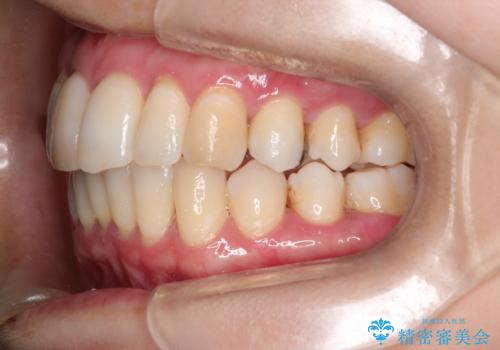 再矯正をインビザラインで目立たず手軽にの治療後