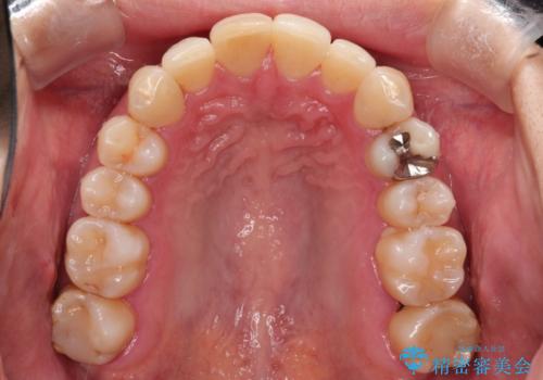 再矯正をインビザラインで目立たず手軽にの治療後