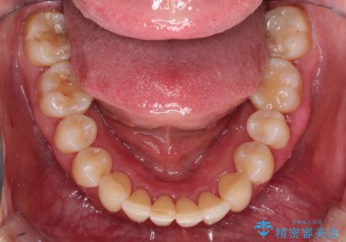 再矯正をインビザラインで目立たず手軽にの治療後