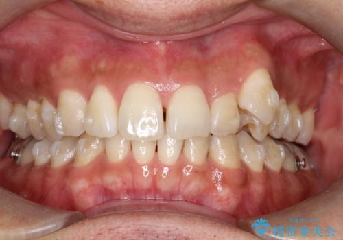 八重歯をインビザラインで矯正 大人の目立たない矯正の治療中