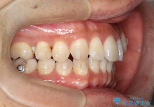 八重歯をインビザラインで矯正 大人の目立たない矯正の治療中
