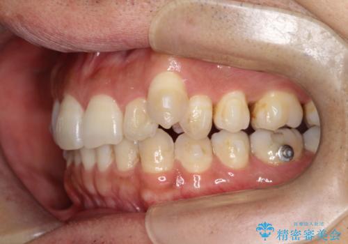 八重歯をインビザラインで矯正 大人の目立たない矯正の治療中