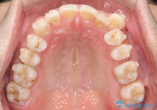 八重歯をインビザラインで矯正　大人の目立たない矯正の治療中