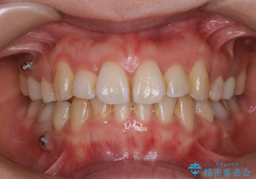 インビザラインの新しいマウスピースが届く前にクリーニング(アタッチメントが外れている時に)の症例 治療前